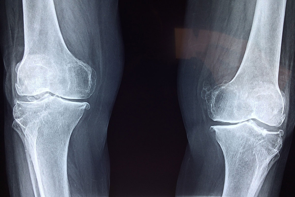 Titelbild zu „Osteoporose – Tipps zur Prävention und Therapie“