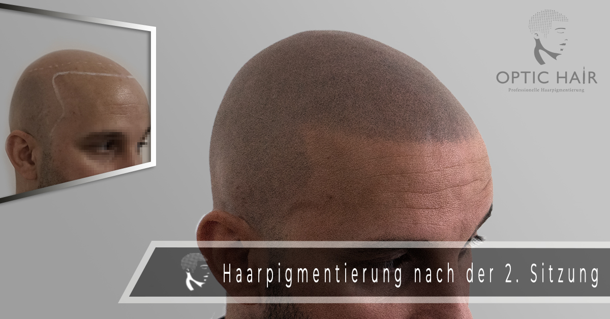 Titelbild zu „Die Haarpigmentierung vorher nachher – natürliche Ergebnisse“