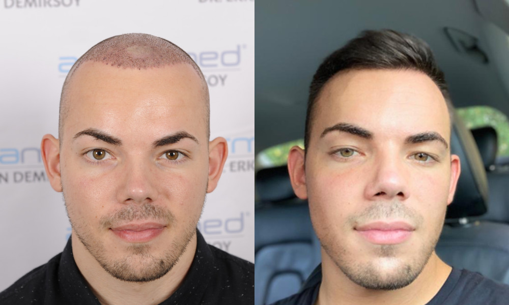 Titelbild zu „Warum eine Haartransplantation in der Türkei?“